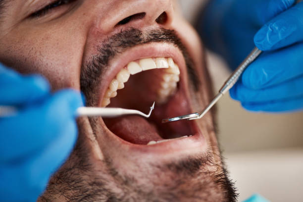 Best Dentist for Tooth Abscess  in Linden, AL